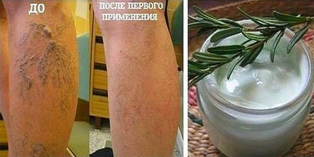 Флебит вены на ноге