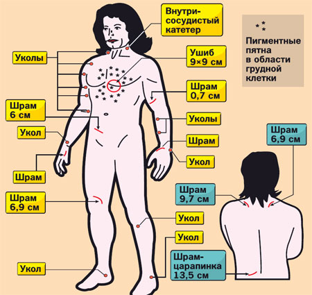 похудеть с помощью активированный уголь