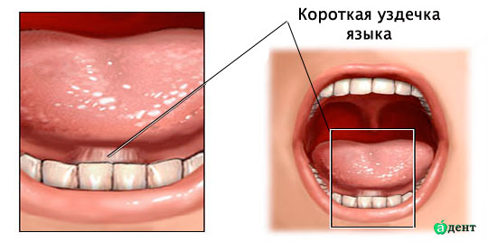 Как избавиться от шепелявости самому