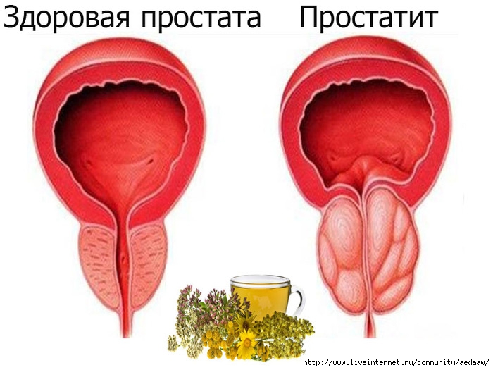 Массажер для лечения простатита и плохой эрекции/5051374_581 (700x525, 167Kb)