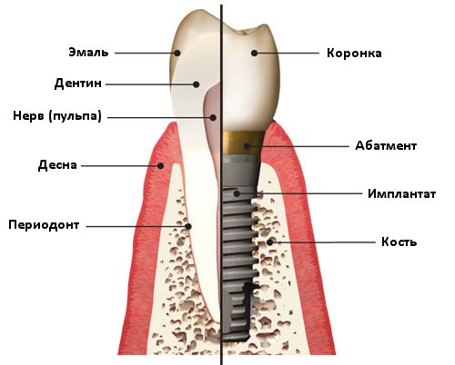 1406640930_dental_implant (500x402, 40Kb)