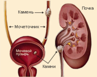 ? 3925311_kamni_v_pochkah (340x272, 77Kb)