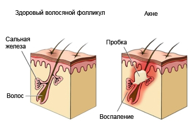 маски для проблемной кожи  Клинолан - настоящее лечебное средство!/4907394_Pimple (380x247, 43Kb)