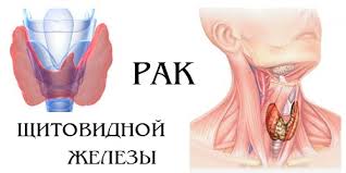 Болезнь щитовидной железы - как остановить разложение организма и не допустить образования рака?/5051374_index (318x159, 7Kb)