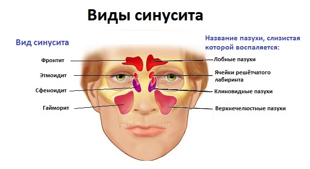 Как лечить гайморит и фронтит в домашних условиях