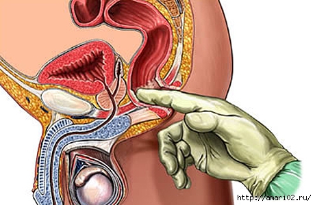proktologia-lechenie (460x300, 114Kb)