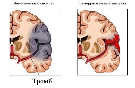 Инсульт первые симптомы...