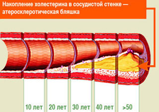 диету при