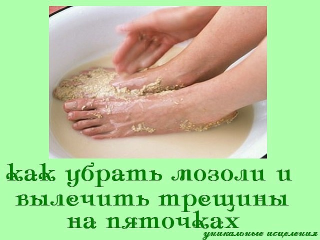 Как в домашних условиях вылечит мозоль Как в домашних условиях вылечит мозоль
