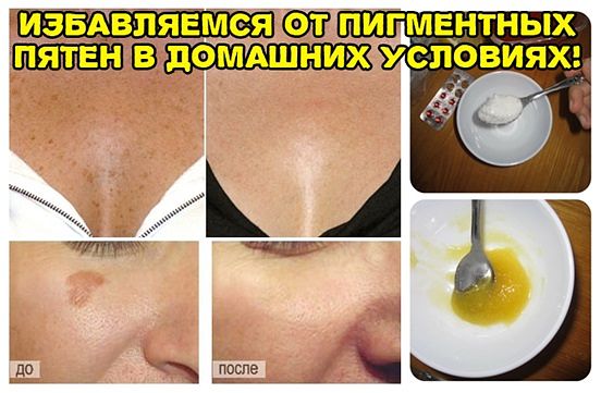 Как убрать возрастные пятна на руках в домашних условиях