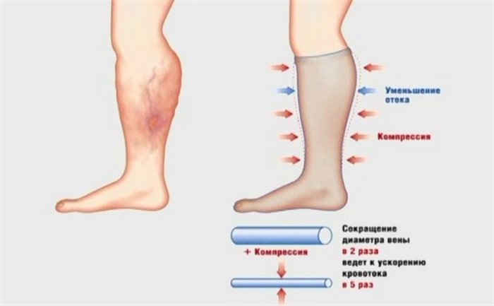 Варикоз Глубоких Вен Нижних Конечностей Цена