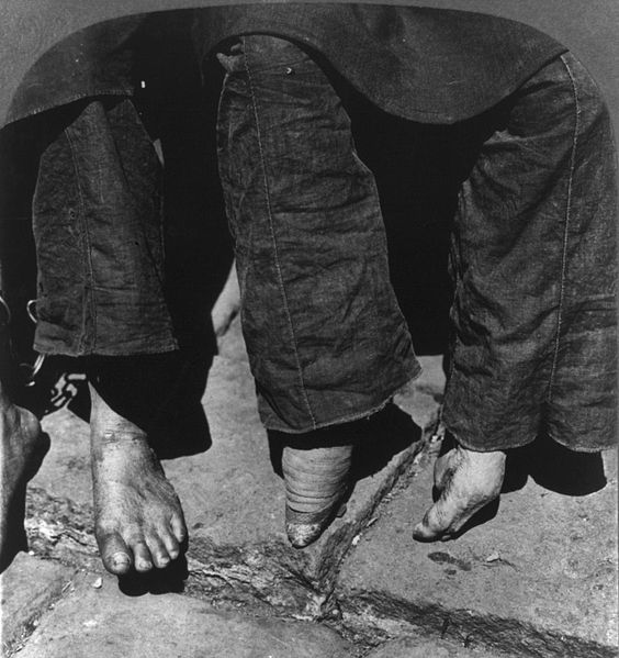 564px-Natural_vs._bound_feet_comparison, _1902 (564x599, 63KB)
