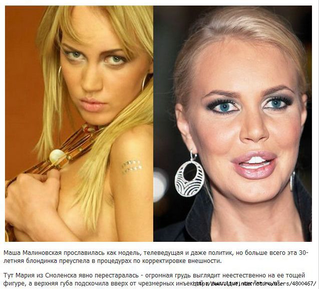 пластика неудачная фото онлайн пластика неудачная фото