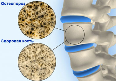 osteoporoz (400x279, 25Kb)