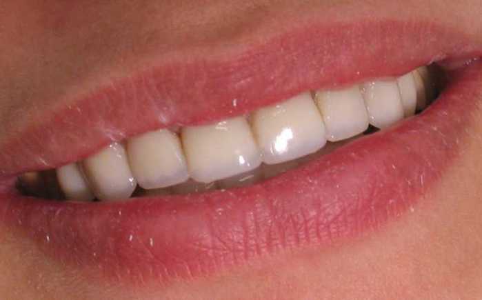 1309282789_teethafter2-1- (700x435, 14Kb)
