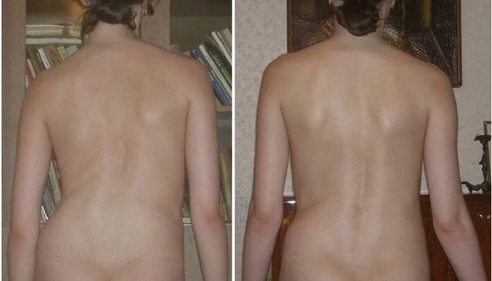 photo-skolioz-maria-big (700x399, 129Kb)