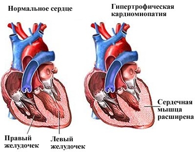 Виферон гель при папилломах