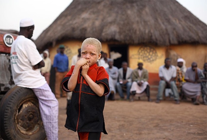 Как в Африке совершают ритуальные убийства детей и альбиносов
