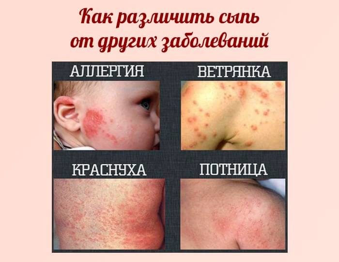 Потничка на спине чем лечить Потничка на спине чем лечить