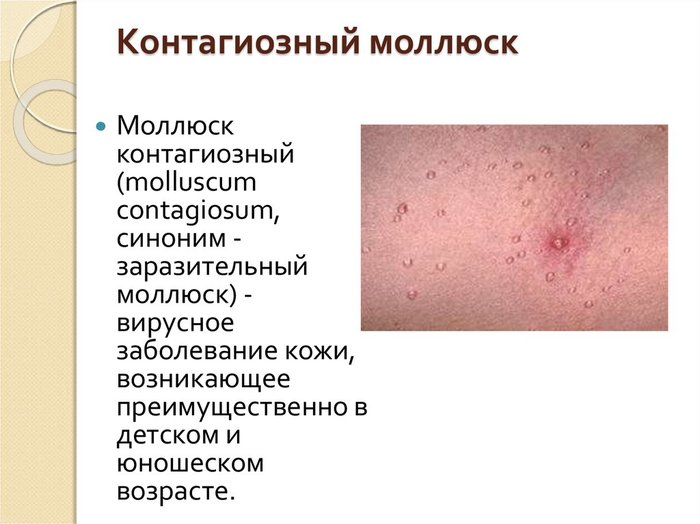 Шелушение на коже при вич Шелушение на коже при вич