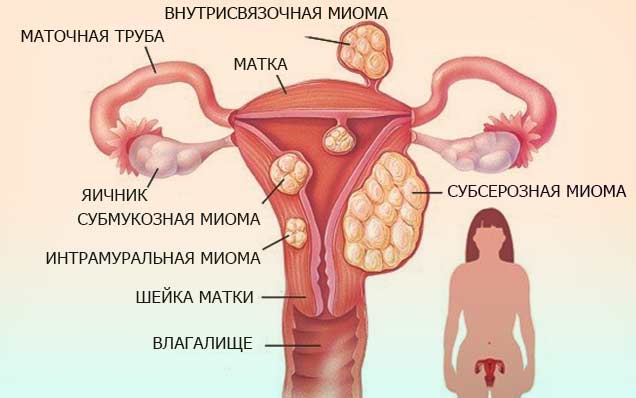 Лечим миому в домашних условиях Лечим миому в домашних условиях