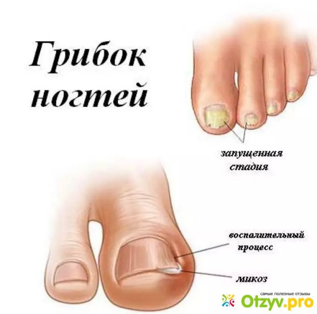 Как выглядит грибок ногтей на руках у ребенка Как выглядит грибок ногтей на руках у ребенка