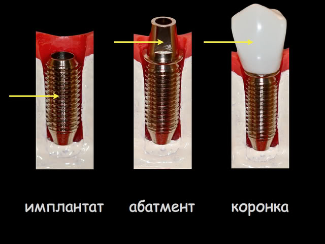 protezirovanie-na-implantah (640x480, 41Kb)