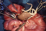 Превью Ascaris_infection-_Difficult_intestinal_anastamosis_-_joining_up_of_two_ends-_clearly_if_we_cut_out_a_section_of_bowel_we're_left_with_two_ends_that_need_to_be_joined_up_(South_Africa)_(15806559973) (575x385, 128Kb)