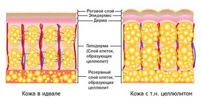 Целлюлитный обман: эксперт рассказал обо всём бреде, который рекламщики впаривают женщинам