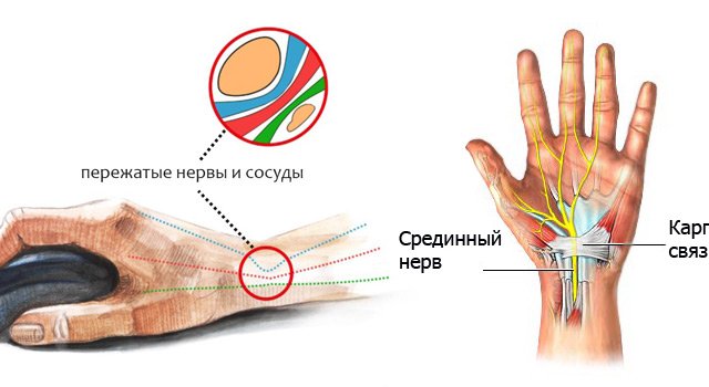 3368205_1440837102_karpalnykanal (640x350, 36Kb)
