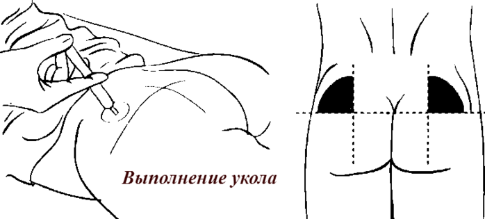 alt="Шишки от уколов на ягодицах и их лечение"/2835299_VIPOLNENIE_YKOLA (700x315, 63Kb)