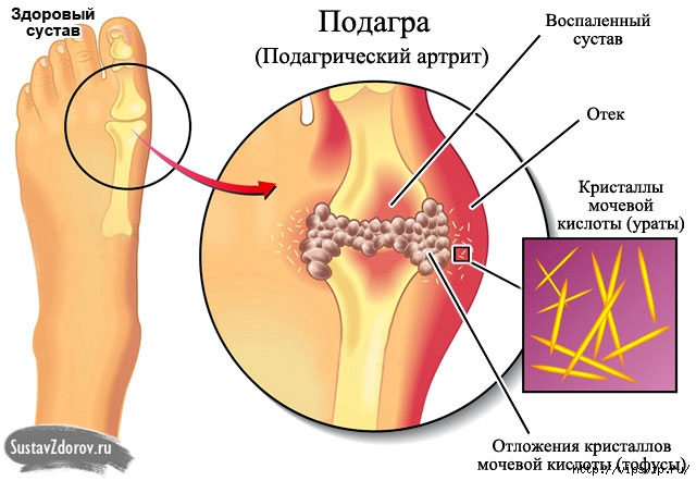 5745884_podagra_mochevaya_kislota_kostochka (640x442, 142Kb)