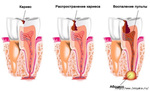 3925073_karies2 (591x360, 99Kb)