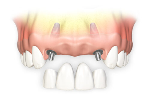 implantaciya-perednih-zubov-e1623841316548 (500x342, 22Kb)