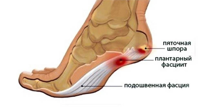 Плантарный фасциит! (700x368, 118Kb)