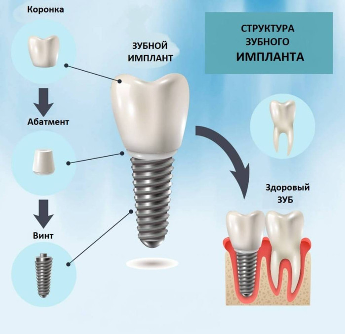 имплантация зубов и их виды 1 (700x676, 228Kb)