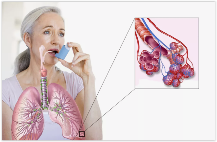 Бронхиальная астма: к какому специалисту обратиться?/3925073_Screen_Shot_101223_at_06_45_PM (700x457, 278Kb)
