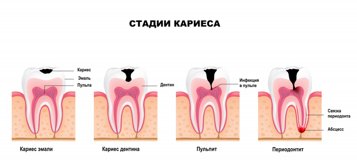 кариес и его стадии развития 1 (700x326, 136Kb)