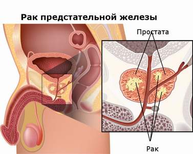 rak-prostat (377x300, 18Kb)