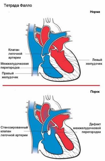 Тетрада фалло гемодинамика схема