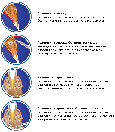 Противопоказание для резекции верхушки корня зуба. Резекция верхушки корня зуба показания. Зубосохраняющие операции показания. Основные методики зубосохраняющих операций. Зубосохраняющие операции клинические случаи.