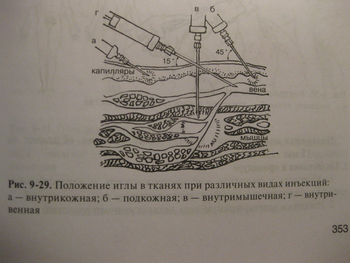 Места внутрикожной инъекции схема