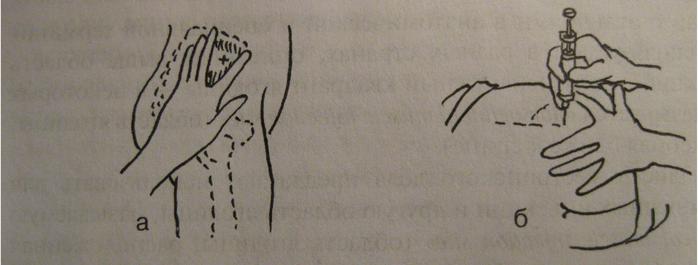 Как делать внутримышечный укол в ягодицу взрослому видео правильно фото домашних условиях