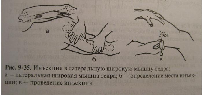 Как ставить в бедро внутримышечно. Постановка инъекции в бедро внутримышечно. Техника введения в/м в бедро.