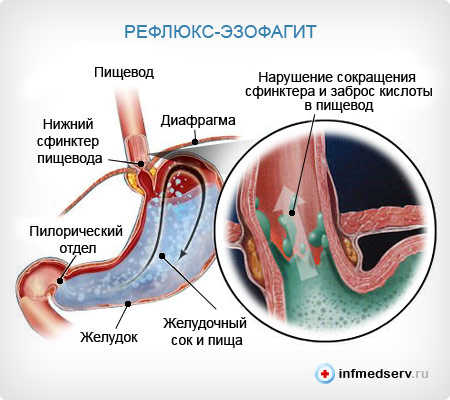диета при эзофагите пищевода диета при эзофагите пищевода