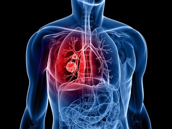 4649929_big_0lungcancerMain (600x450, 38Kb)