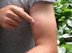 Народные средства от укусов комаров при аллергии thumbnail
