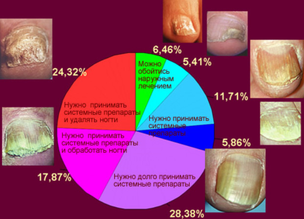 6 способов безопасного лечения грибка на ногах в домашних условиях