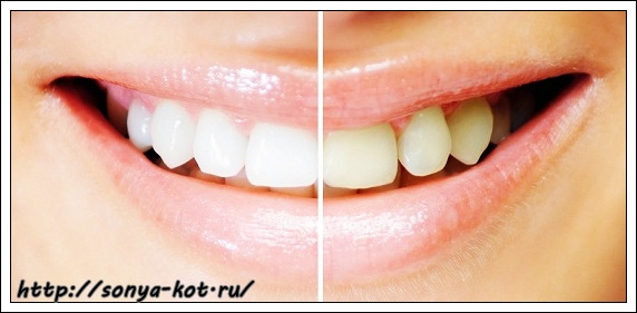 1363684091_teeth-whitening-results2 (572x281, 106Kb)