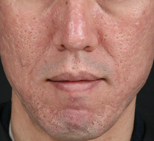 acne scar 2 (633x581, 197Kb)